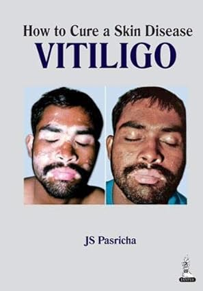 How to Cure a Skin Disease Vitiligo