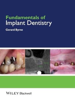 Fundamentals of Implant Dentistry
