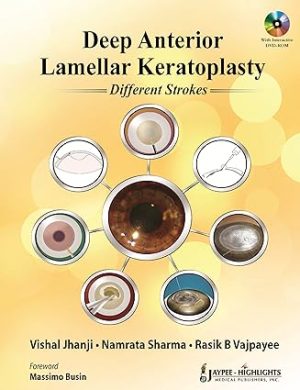 Deep Anterior Lamellar Keratoplasty Different Strokes