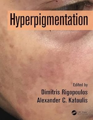 Hyperpigmentation